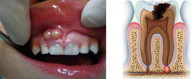 Apikal periodontit: symptom, diagnos, behandling