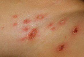 Streptodermia: Är denna sjukdom smittsam eller inte?